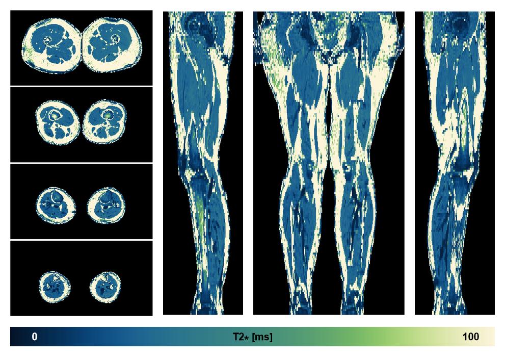The T2 star relaxation time of the lower extremity obtained from the dixon reconstruction for muscle water fat quantification.